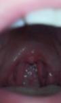 Красное горло с бугристыми мендалинами фото 2