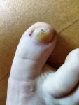 Заболевание ногтевой пластины большого пальца ноги фото 2