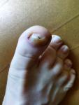Заболевание ногтевой пластины большого пальца ноги фото 3