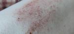 Воспаление кожи (период лактации) фото 2