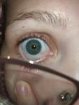 Расширенные капилляры глаз фото 3