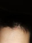 Симптомы Зуд, шелушение, перхоть, выпадают волосы с черным корнем фото 1