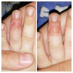 Воспаление пальца после укуса другого ребенка фото 1