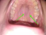 Сильная боль и пульсация в нёбе после депульпирования зуба фото 1