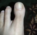 Грибок ногтя или травма ногтя фото 1