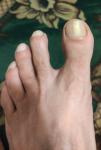 Грибок ногтя или травма ногтя фото 2