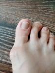 Полоска на ногте большого пальца ноги фото 1