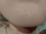 Странная сыпь на лице у ребенка, не беспокоит фото 2