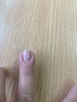 Пузырьки и опухлость пальца вокруг ногтя фото 3