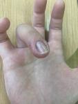 Пузырьки и опухлость пальца вокруг ногтя фото 1