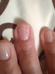 Черная точка-риска на ногте, которая отрастает и снова появляется фото 5