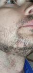 Белые пятна волос в бороде фото 2