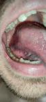 Болит язык, рана на языке фото 5