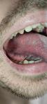 Болит язык, рана на языке фото 4