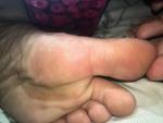 Розовое пятно на ноге уже год фото 1