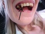 Импланты и зуб фото 1