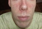 Себорейный дерматит лица фото 1