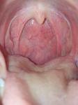 Воспаленные сосуды в горле, боль фото 1