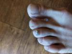 Грибок ногтя на ноге фото 2