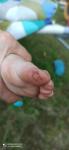 Глубокие трещины на пальцах ног фото 1