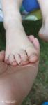 Глубокие трещины на пальцах ног фото 3