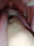 Бугры на корне языка, ощущения инородного тела в горле. Пробки фото 1