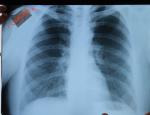 Расшифровка рентгена лёгких фото 2