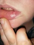 Образование на слизистой нижней губы фото 2