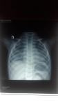 Подозрение на пневмонию у ребенка по снимку фото 1