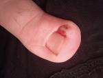 После удаления вросшего ногтя, палец гноиться фото 1