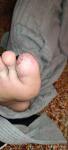 Болячка на большом пальце ноги фото 1