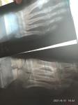 Перелом основания 5 плюсневой кости фото 1