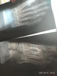 Перелом основания 5 плюсневой кости фото 2