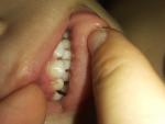 Чёрное пятно на молочном зубе фото 1