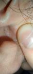 Пыпырышек на мочке уха фото 2