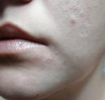 Шелушение кожи вокруг губ фото 1
