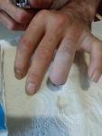 Ампутация фаланги пальца на руке фото 2