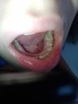 Болит зуб образовался нарост фото 1