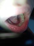 Болит зуб образовался нарост фото 2