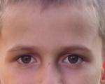 Разный размер глаз у ребенка фото 3