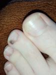 Тёмное пятно на ногте указательного пальца фото 2