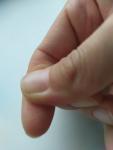 Подкожные кровавые пятнышки на кончике пальца руки фото 1