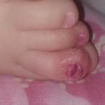 Шелушиться палец ноги и сходит ноготь у ребенка фото 2