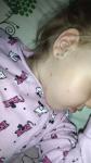 Болячки на лице у ребенка 2 года без температуры, только насморк фото 1