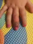 Палец у ребенка опух и потрескался фото 1