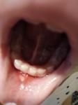 Стоматит у ребёнка 4 лет, одна язва на внутренней стороне губы фото 1