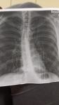 Сколиоз на рентгене грудной клетки фото 1