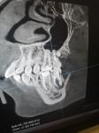 Шишка на десне, лечение или удаление зуба фото 1
