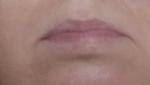 Отёчность нижней губы фото 5