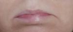Отёчность нижней губы фото 3